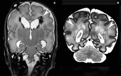 Frontiers | Prevention, Reduction And Repair Of Brain Injury Of The ...